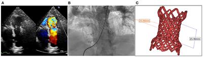 Case report: Transcatheter pulmonary valve-in-valve implantation in a deteriorated self-expandable valve caused by infective endocarditis